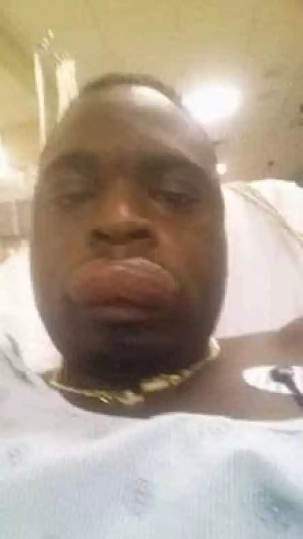 Guy lands in hospital with swollen lip after giving oral s*x to woman with STD (photo)